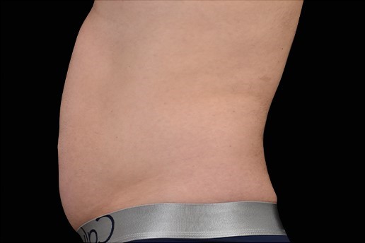 Before Image: Abdomen - left-side