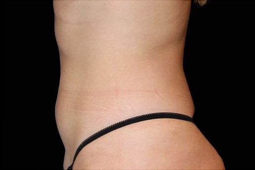 After Image: Abdomen - left-side