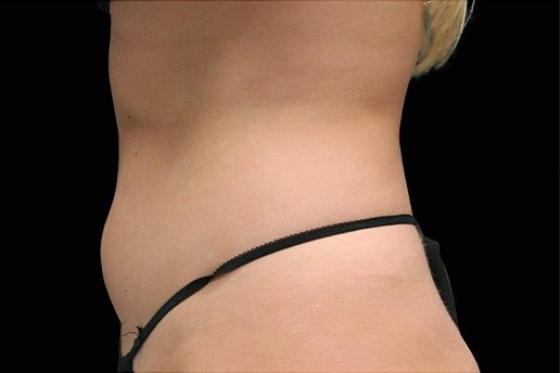 Before Image: Abdomen - left-side