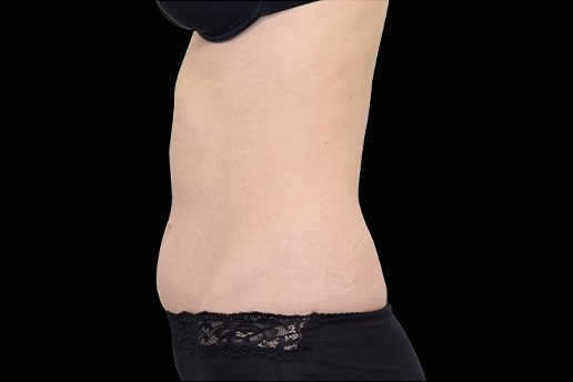 After Image: Abdomen - left-side