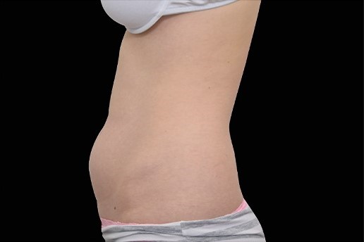 Before Image: Abdomen - left-side