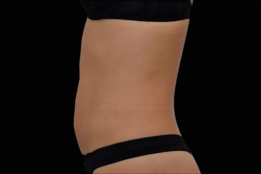 After Image: Abdomen - left-side