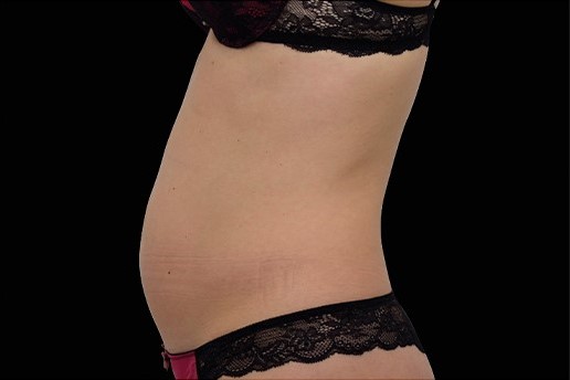 Before Image: Abdomen - left-side