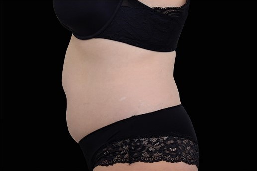 After Image: Abdomen - left-side