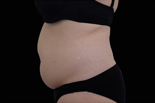 Before Image: Abdomen - left-side