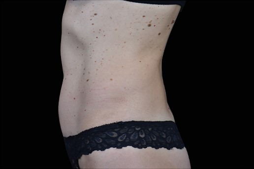 After Image: Abdomen - left-side