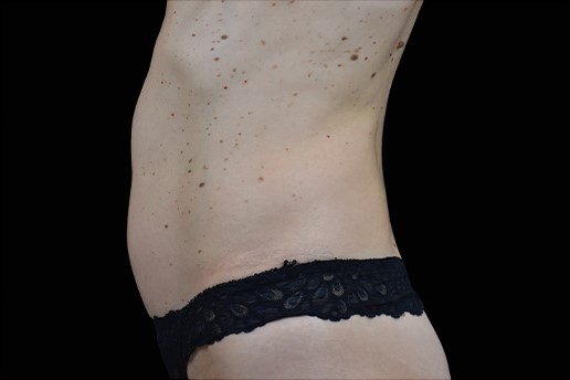 Before Image: Abdomen - left-side