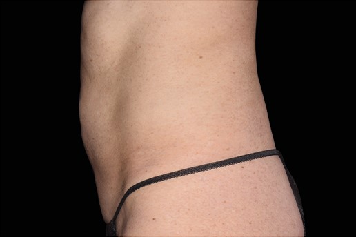 After Image: Abdomen - left-side
