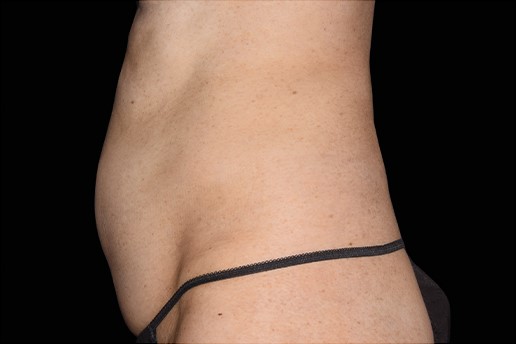 Before Image: Abdomen - left-side