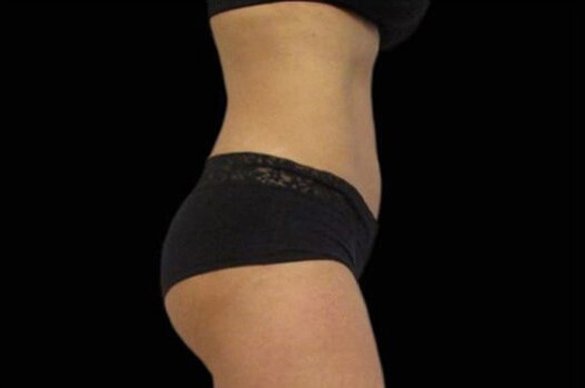 After Image: Abdomen - right-side