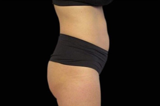 Before Image: Abdomen - right-side