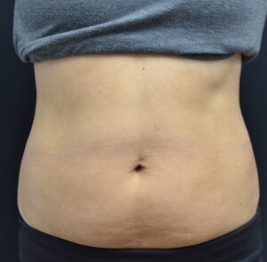 After Image: Abdomen