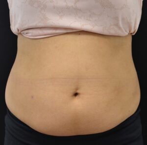 Before Image: Abdomen