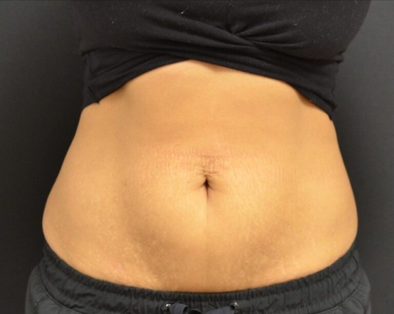 After Image: Abdomen - front