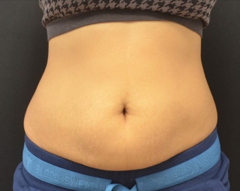 Before Image: Abdomen - front