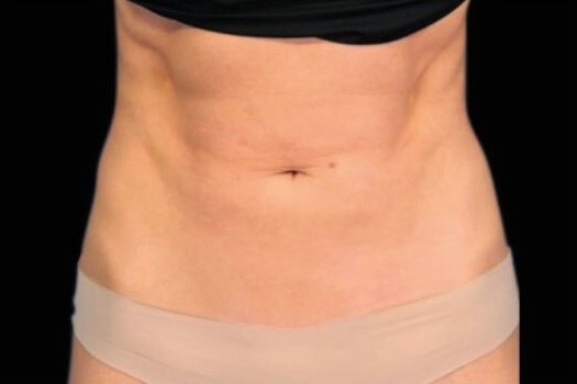 After Image: Abdomen - front