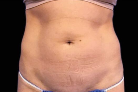 Before Image: Abdomen - front