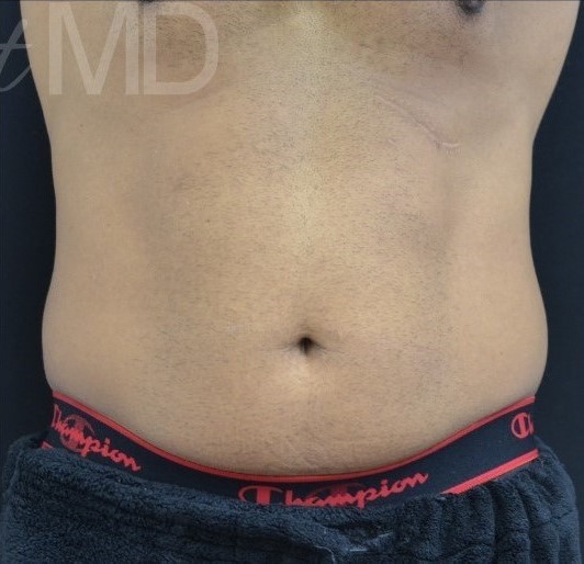 After Image: Abdomen - front
