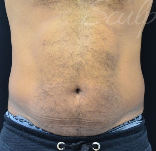 Before Image: Abdomen - front
