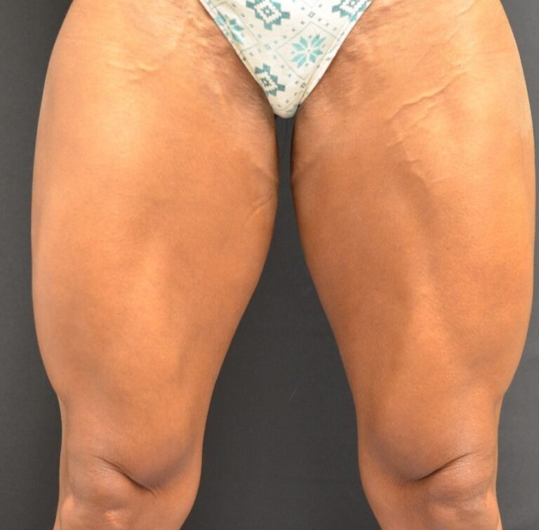 After Image: Front-Thighs - front