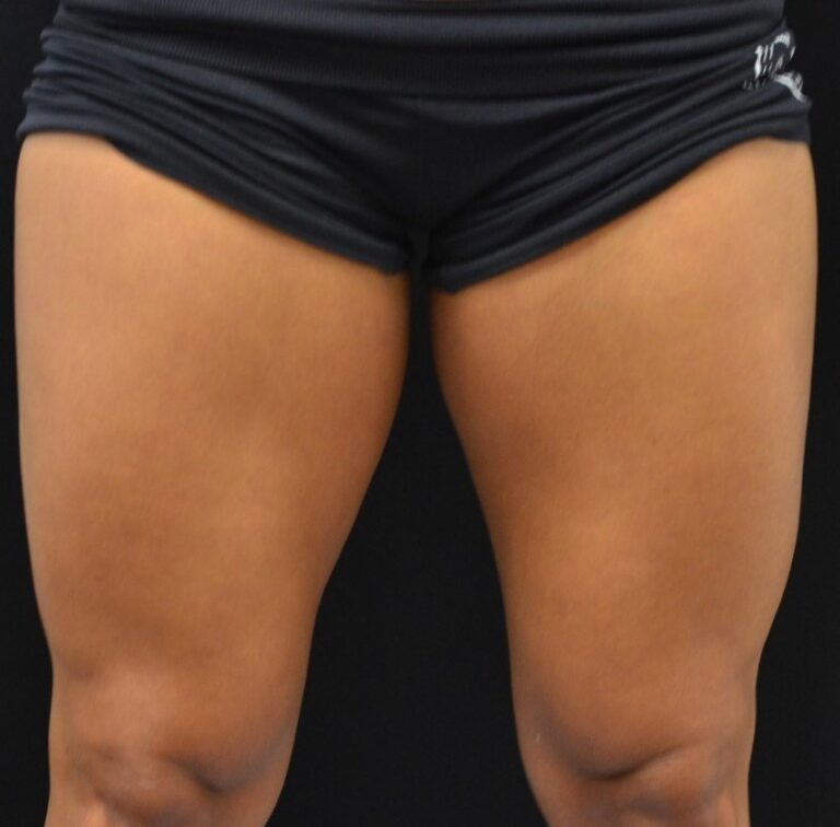 Before Image: Front-Thighs - front