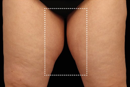 After Image: Inner-Thighs - front
