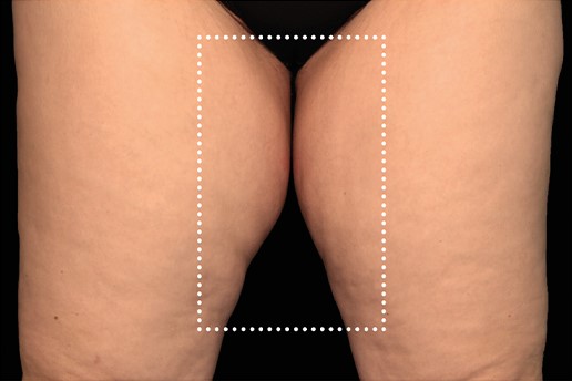 Before Image: Inner-Thighs - front