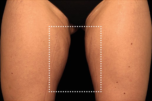After Image: Inner-Thighs - front