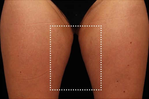 Before Image: Inner-Thighs - front