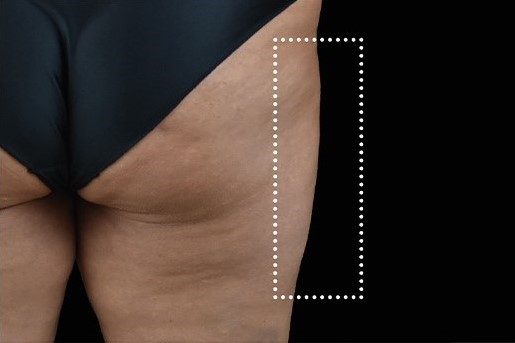 After Image: Outer-Thighs - back
