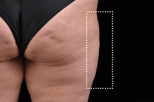 Before Image: Outer-Thighs - back