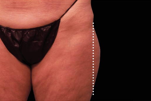 Before Image: Outer-Thighs - front