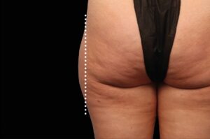 After Image: Outer-Thighs