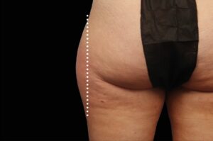 Before Image: Outer-Thighs