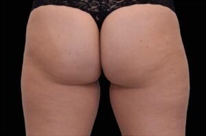 After Image: Outer-Thighs