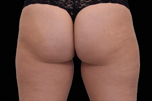 After Image: Outer-Thighs - back