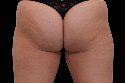 Before Image: Outer-Thighs - back