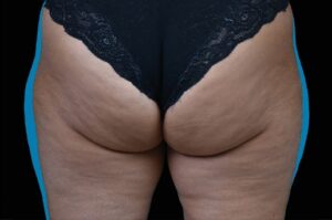 After Image: Outer-Thighs