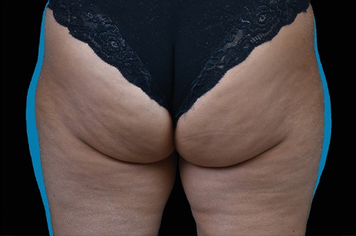 After Image: Outer-Thighs - back