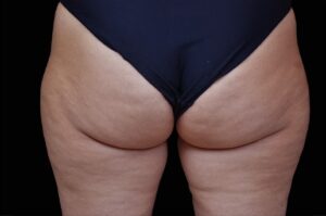 Before Image: Outer-Thighs