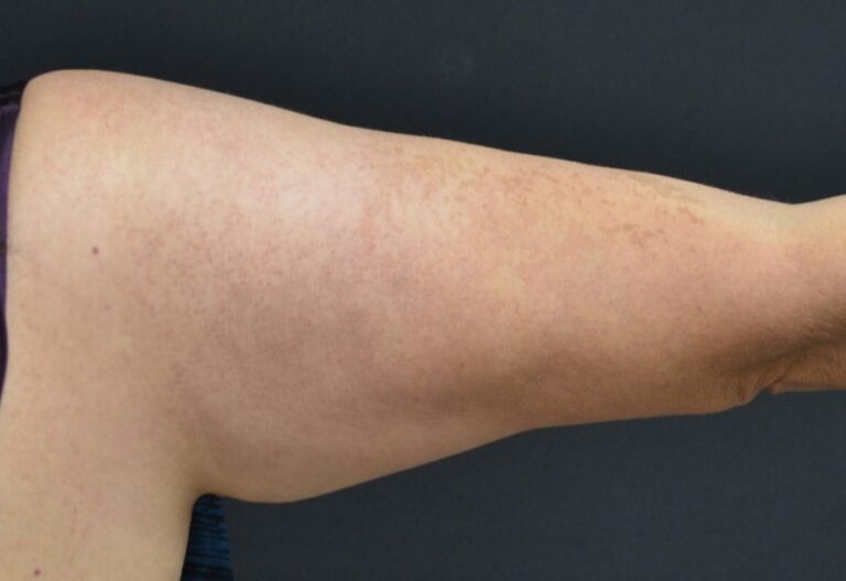 After Image: Triceps - back