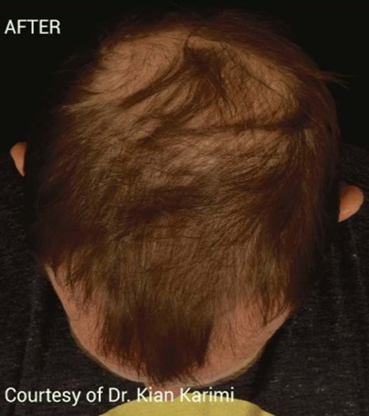 After Image: PRF Hair Restoration - front