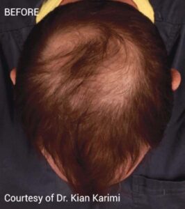Before Image: PRF Hair Restoration