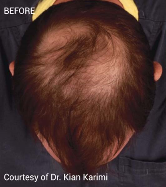 Before Image: PRF Hair Restoration - front