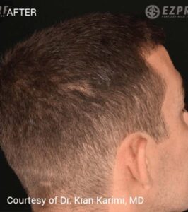 After Image: PRF Hair Restoration