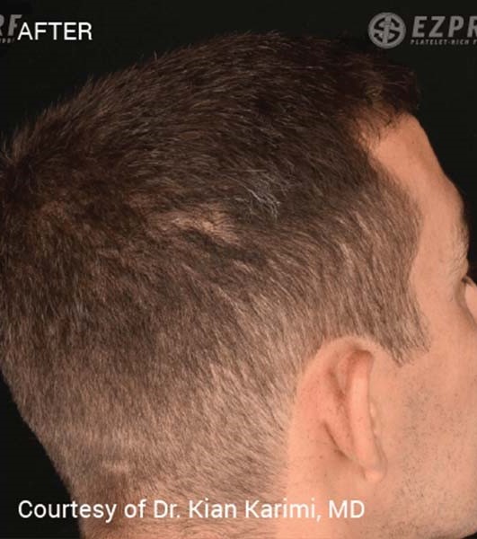 After Image: PRF Hair Restoration - right-back-oblique