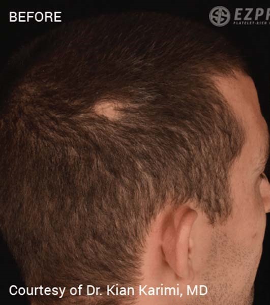 Before Image: PRF Hair Restoration - right-back-oblique
