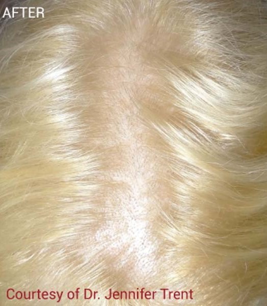 After Image: PRF Hair Restoration - front