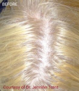 Before Image: PRF Hair Restoration