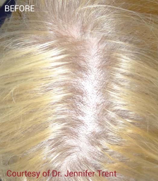 Before Image: PRF Hair Restoration - front